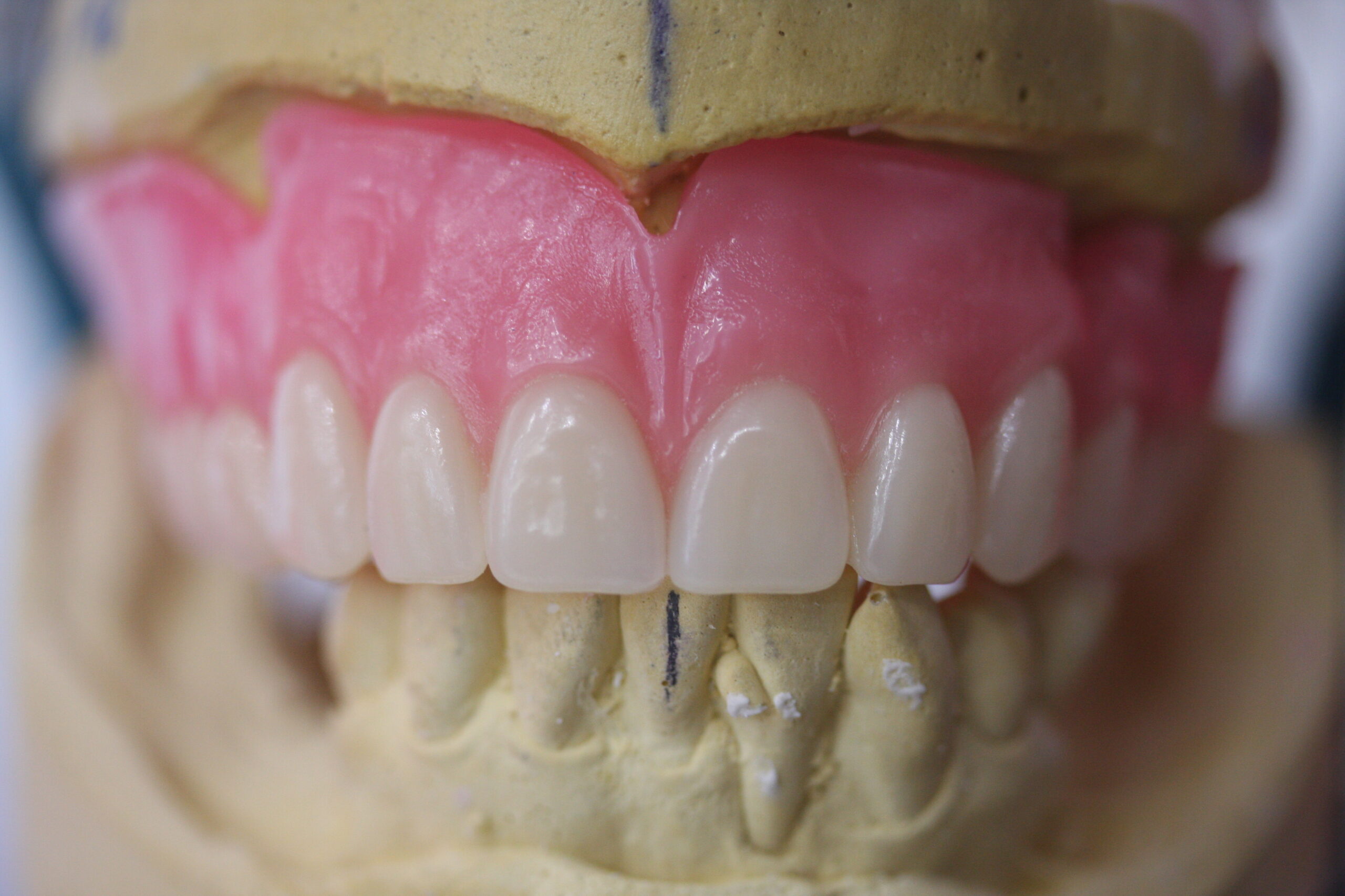 Full set of upper and lower dentures on a dental model showing detailed tooth alignment.