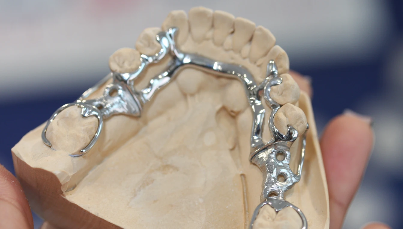 Metal framework for a removable partial denture on a dental cast.